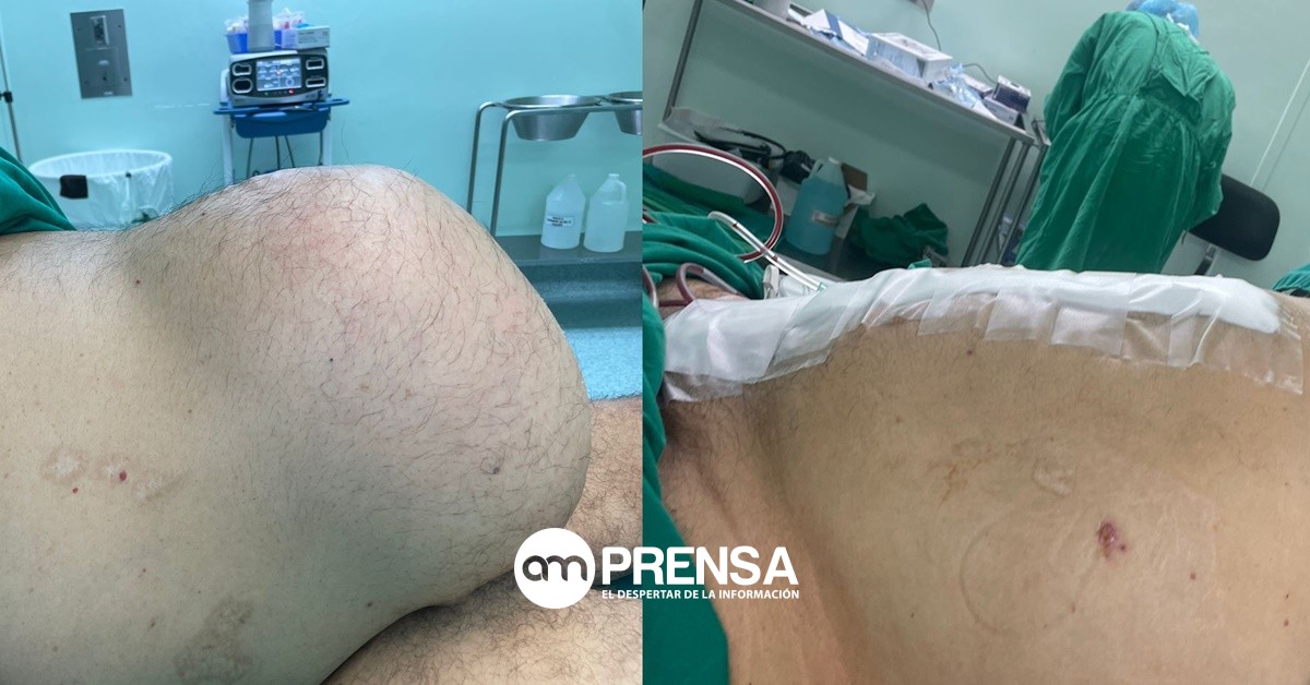Cirujanos de Liberia realizaron exitosa cirugía de hernia gigante